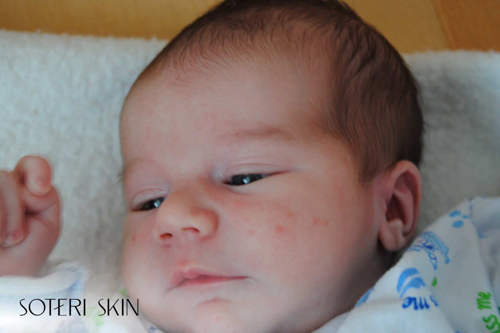 Baby Acne Treatment Guide for Parents: From Causes to Care